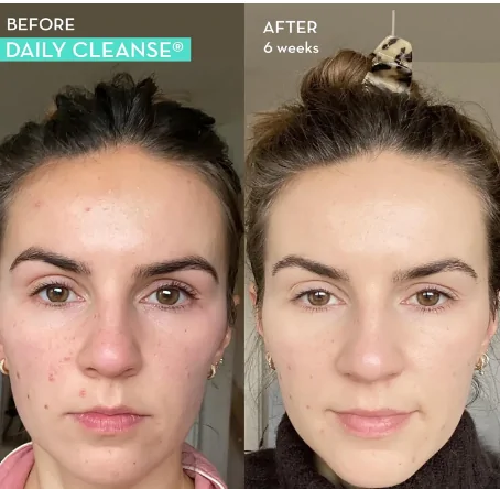 What to Eat to Have Clear Skin