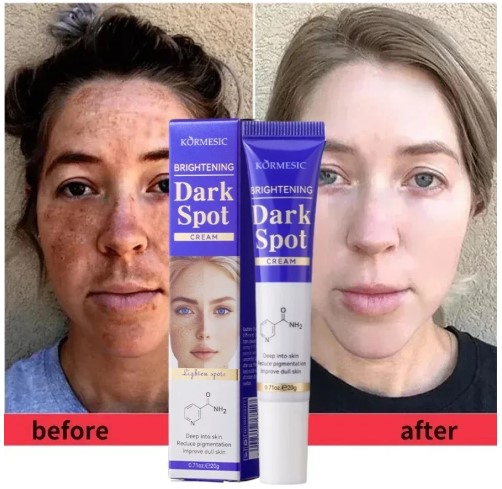 Dark Spots Removal Cream Review: The Ultimate Solution for Facial Whitening, Freckle, and Acne Mark Correction 7 Dark Spots Removal Cream Review
