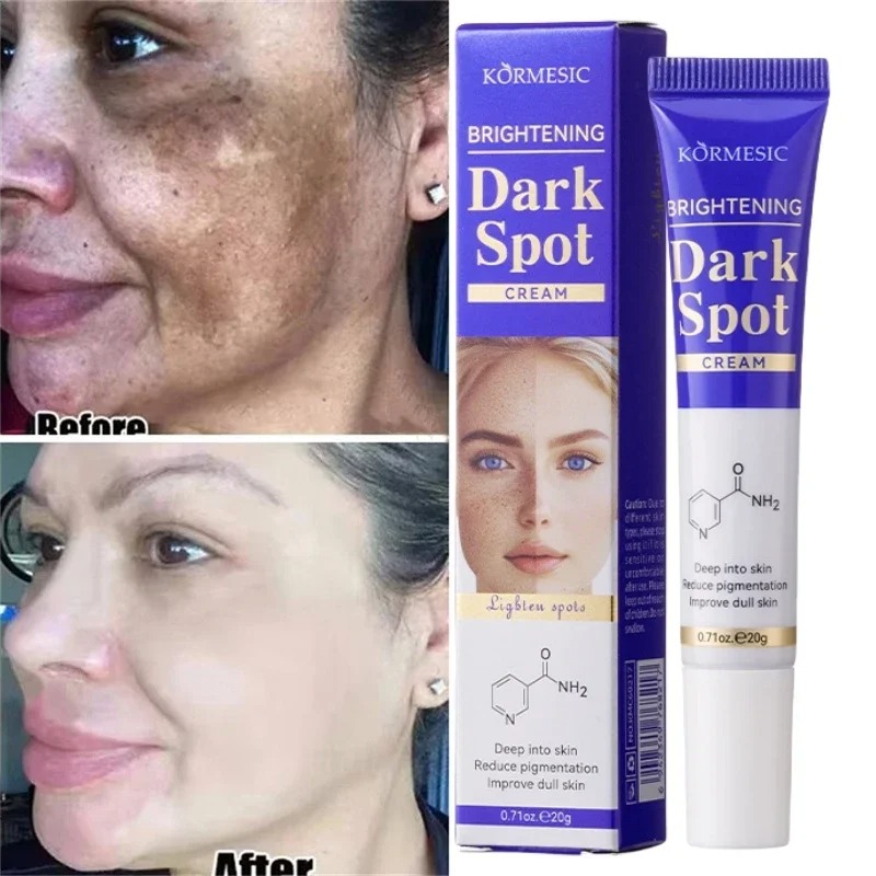 Dark Spots Removal Cream Review: The Ultimate Solution for Facial Whitening, Freckle, and Acne Mark Correction 4 Dark Spots Removal Cream Review