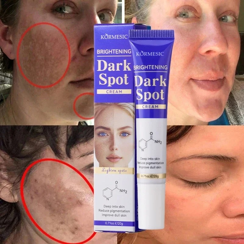 Dark Spots Removal Cream Review: The Ultimate Solution for Facial Whitening, Freckle, and Acne Mark Correction 8 Dark Spots Removal Cream Review